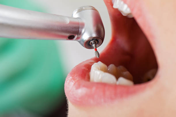 Best Urgent Care for Lost Fillings or Crowns in Ebensburg, PA
